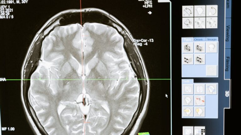 Découverte japonaise sur la « graine » liée à Alzheimer : pas de révolution dans la recherche.