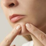 Acné : recommandations des dermatologues sur le perçage des boutons en France