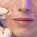 Urgence de stopper les injections esthétiques illégales, alerte le syndicat de chirurgie plastique.
