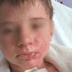 Un jouet à la mode explose au visage d&rsquo;un enfant de 8 ans, entraînant des brûlures et une hospitalisation.