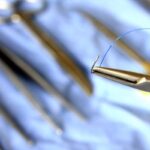 Le cerclage du col de l&rsquo;utérus : une procédure recommandée par des experts médicaux en France.