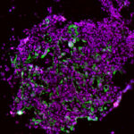 Un médicament ciblant une enzyme inflammatoire pourrait réduire le risque de cancer du poumon.