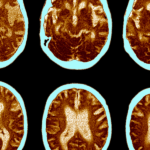 Recherches du Pr J. Dumont sur la génétique et la maladie d&rsquo;Alzheimer en France.