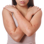 Webinaire sur les scarifications à l&rsquo;adolescence : enjeux et réalités en France.