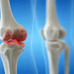 Des études montrent que l’arthrose du genou peut être évitée par des mesures préventives.