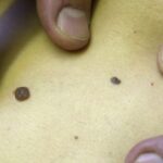 Le vaccin contre le cancer de la peau soulève des espoirs selon l’oncologue Suzette Delaloge.