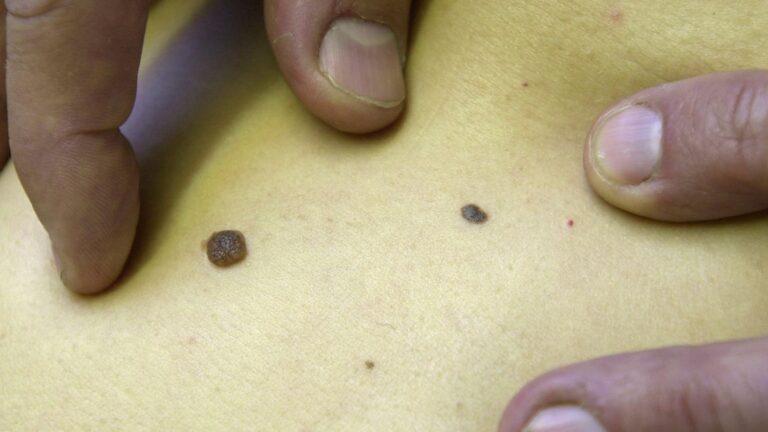 Le vaccin contre le cancer de la peau soulève des espoirs selon l’oncologue Suzette Delaloge.