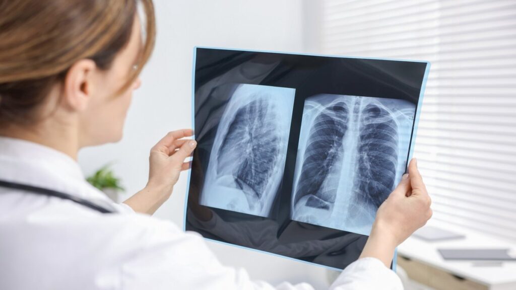 Le rôle du sucre dans la progression des tumeurs du cancer du poumon identifié par des chercheurs.
