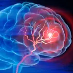 Un traitement injectable aide le cerveau à se reconstruire après un AVC, selon des chercheurs.
