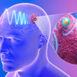 Des nanodispositifs injectables offrent un traitement prometteur contre le glioblastome résistant.