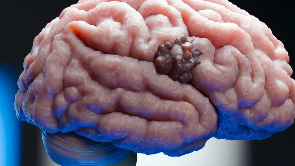 Des chercheurs identifient une vulnérabilité dans un des cancers cérébraux les plus mortels.