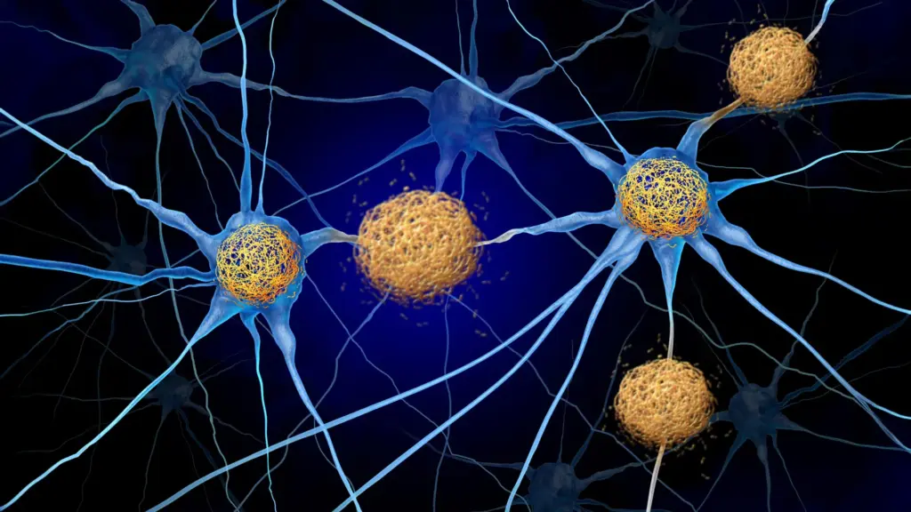 Alzheimer : des changements cérébraux détectés avant l’apparition des plaques amyloïdes.