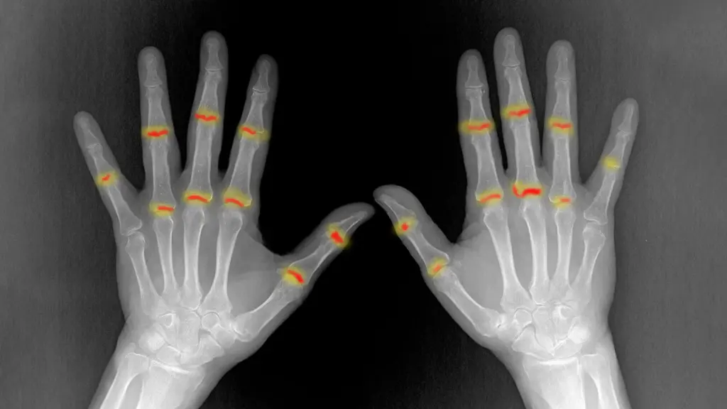 Des études révèlent que certains joints peuvent être prédisposés à la polyarthrite rhumatoïde dès la naissance.